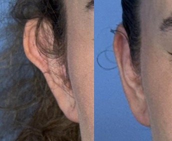Cicatriz de otoplastia aproximadamente três meses após a cirurgia
