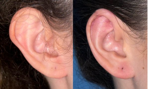 Evolução da cicatriz de otoplastia aproximadamente três meses após a cirurgia